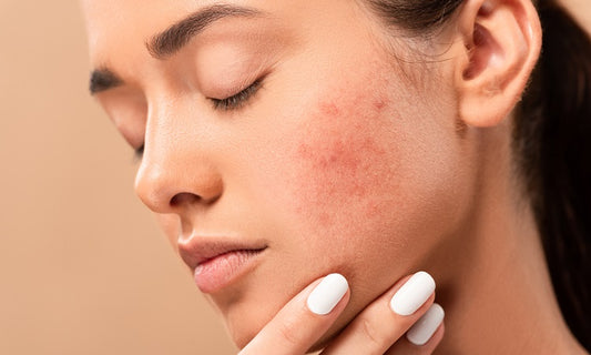You Vs. Acne Scars: Here's How You Can Win This Battle
